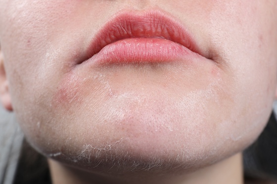 Mund- und Kinnpartie mit trockener Haut - welches Fruchtsäure-Peeling bei trockener Haut?